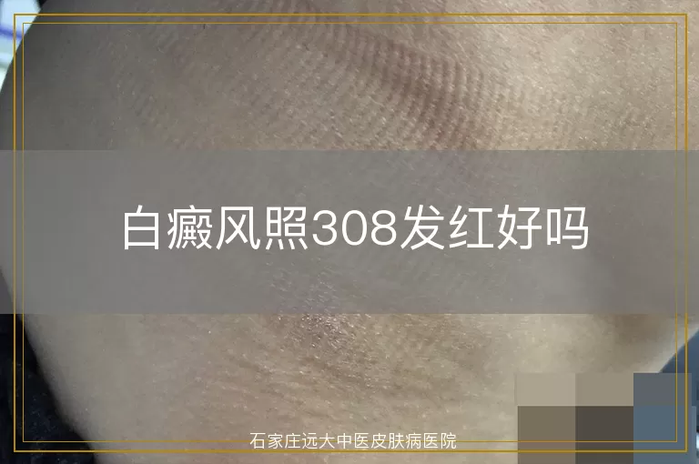 白癜风照308发红好吗