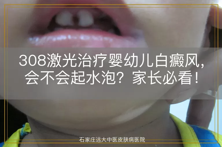 308激光治疗婴幼儿白癜风，会不会起水泡？家长必看！