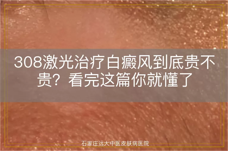 308激光治疗白癜风到底贵不贵？看完这篇你就懂了