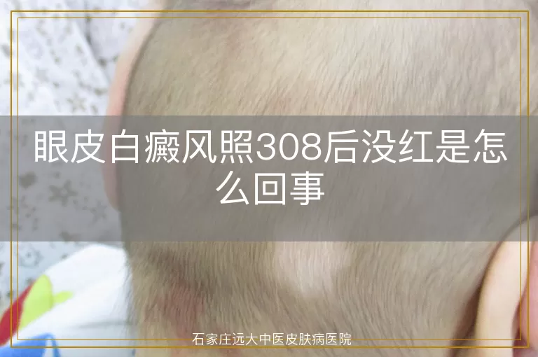 眼皮白癜风照308后没红是怎么回事