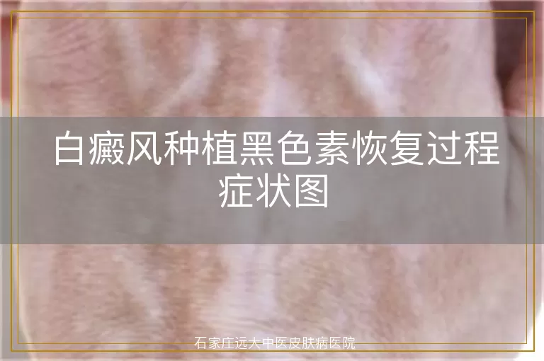 白癜风种植黑色素恢复过程症状图