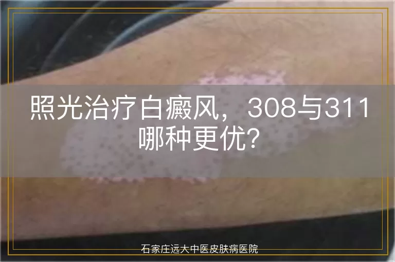 照光治疗白癜风，308与311哪种更优？