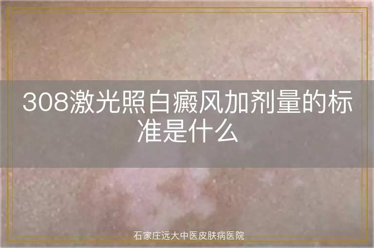 308激光照白癜风加剂量的标准是什么