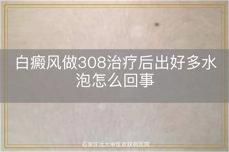 白癜风做308治疗后出好多水泡怎么回事