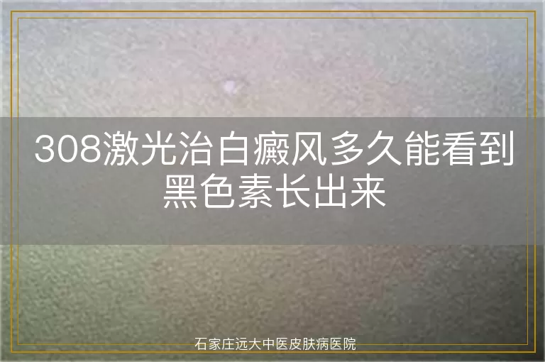 308激光治白癜风多久能看到黑色素长出来