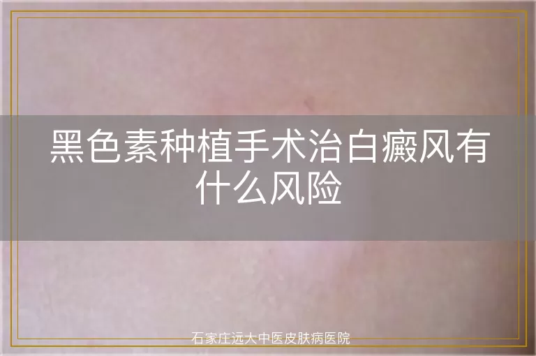 黑色素种植手术治白癜风有什么风险