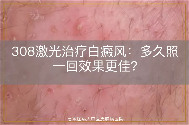 308激光治疗白癜风：多久照一回效果更佳？