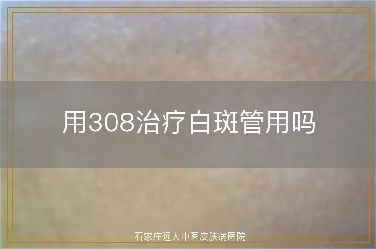 用308治疗白斑管用吗