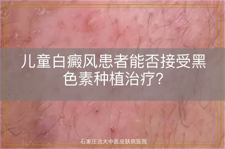 儿童白癜风患者能否接受黑色素种植治疗？