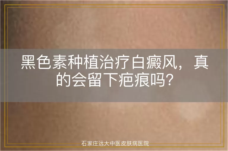 黑色素种植治疗白癜风，真的会留下疤痕吗？