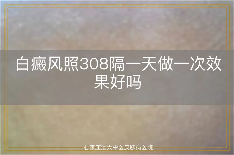 白癜风照308隔一天做一次效果好吗