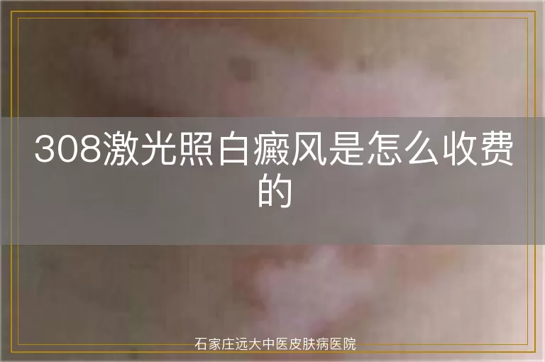 308激光照白癜风是怎么收费的