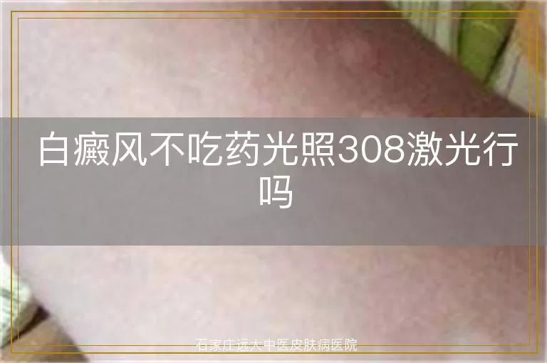 白癜风不吃药光照308激光行吗