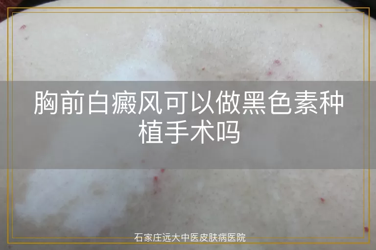 胸前白癜风可以做黑色素种植手术吗