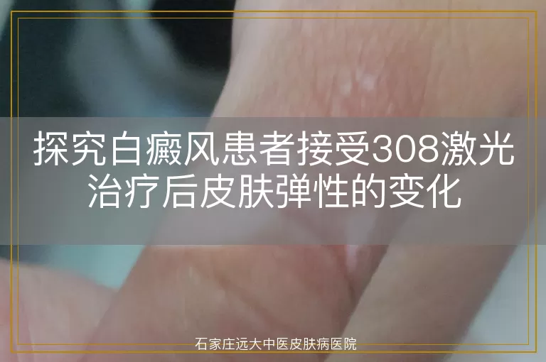 探究白癜风患者接受308激光治疗后皮肤弹性的变化