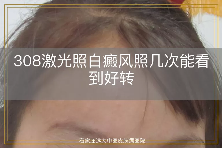 308激光照白癜风照几次能看到好转
