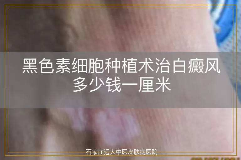 黑色素细胞种植术治白癜风多少钱一厘米
