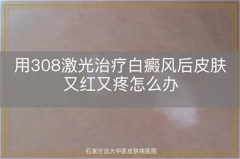 用308激光治疗白癜风后皮肤又红又疼怎么办