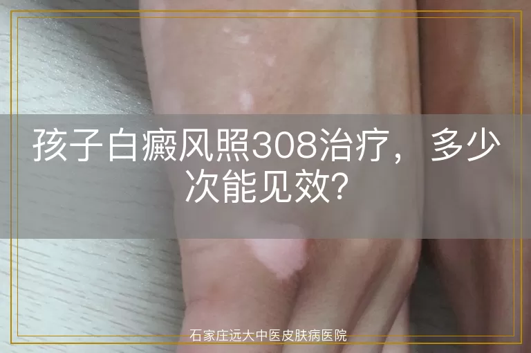 孩子白癜风照308治疗，多少次能见效？