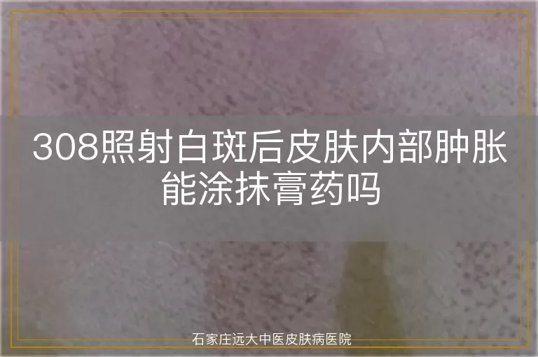 308照射白斑后皮肤内部肿胀能涂抹膏药吗