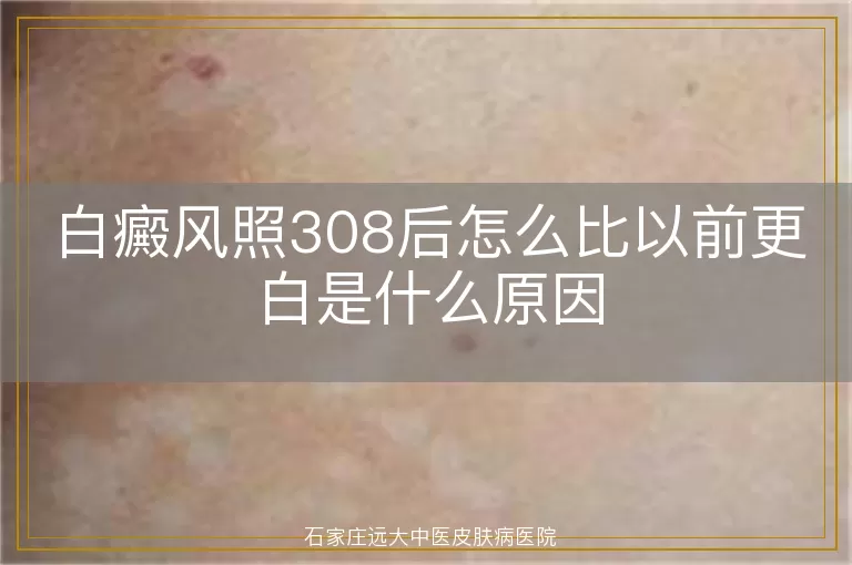 白癜风照308后怎么比以前更白是什么原因