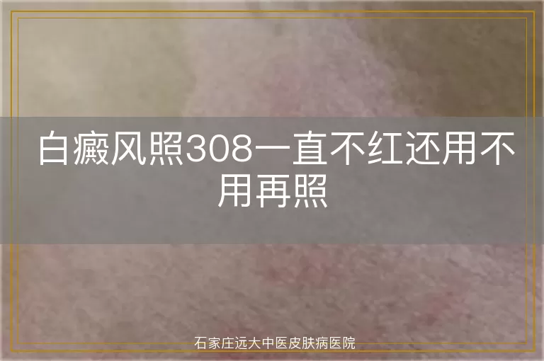 白癜风照308一直不红还用不用再照