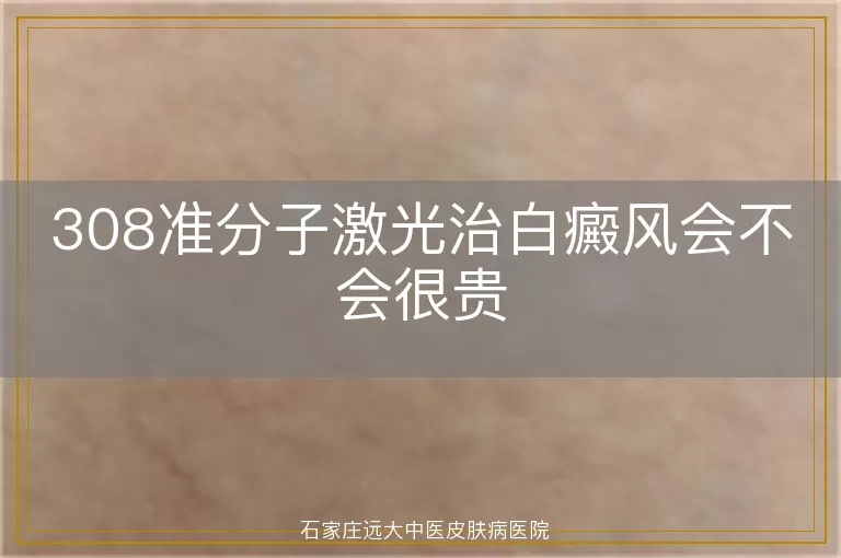 308准分子激光治白癜风会不会很贵