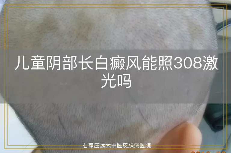 儿童阴部长白癜风能照308激光吗