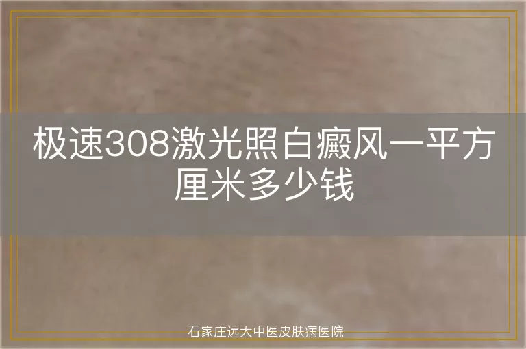 极速308激光照白癜风一平方厘米多少钱