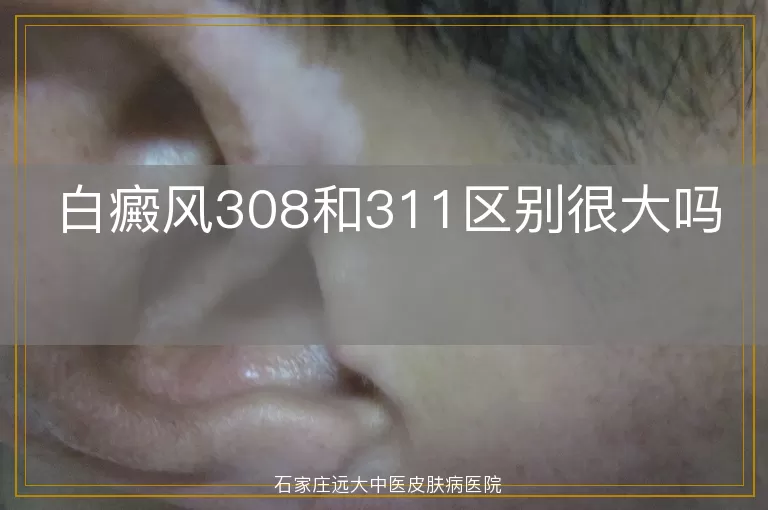 白癜风308和311区别很大吗