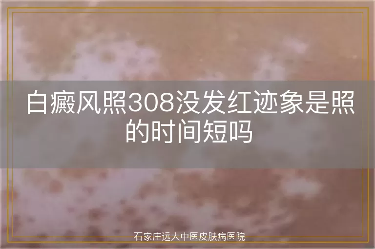 白癜风照308没发红迹象是照的时间短吗