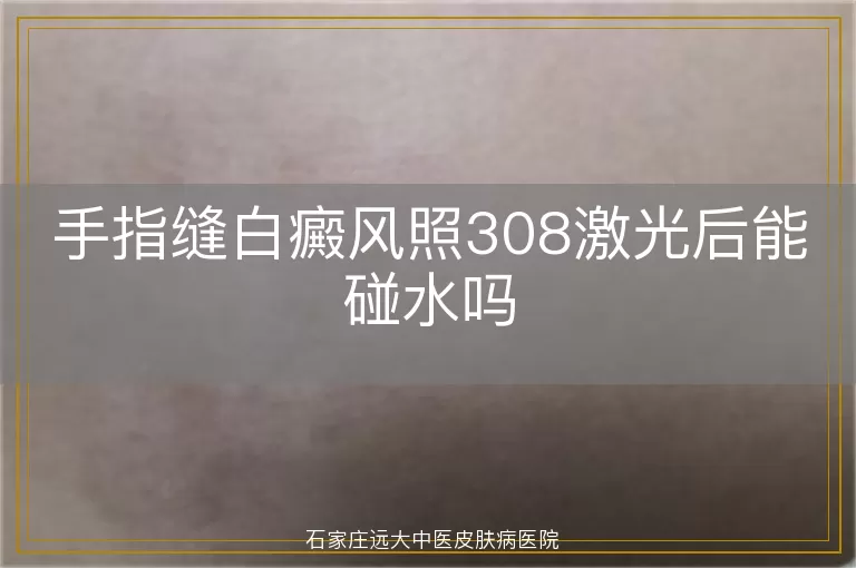 手指缝白癜风照308激光后能碰水吗