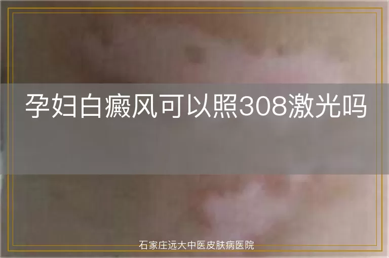 孕妇白癜风可以照308激光吗