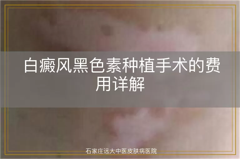 白癜风黑色素种植手术的费用详解