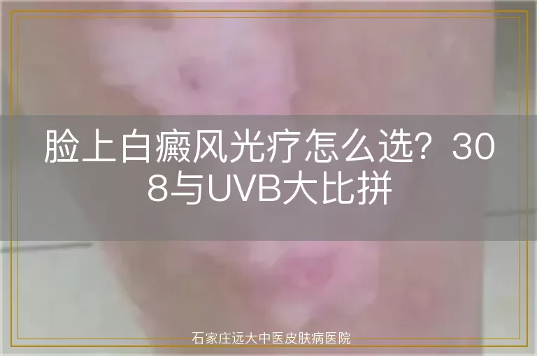 脸上白癜风光疗怎么选？308与UVB大比拼
