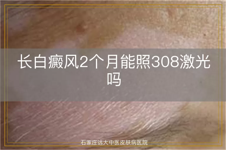 长白癜风2个月能照308激光吗