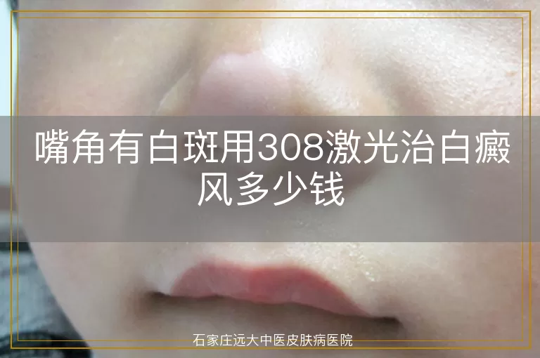 嘴角有白斑用308激光治白癜风多少钱