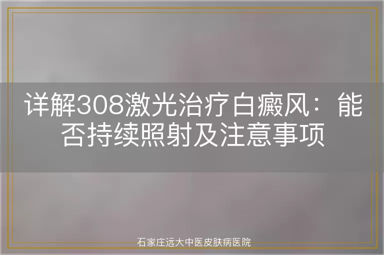 详解308激光治疗白癜风：能否持续照射及注意事项