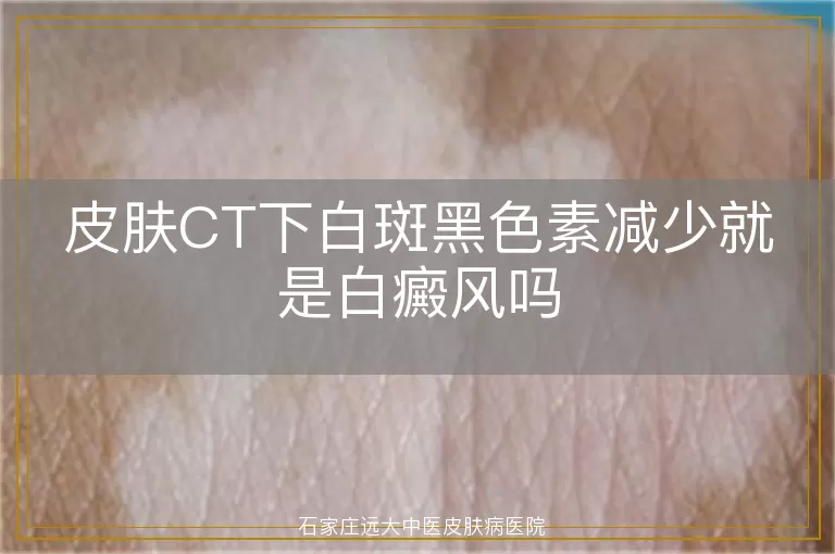皮肤CT下白斑黑色素减少就是白癜风吗