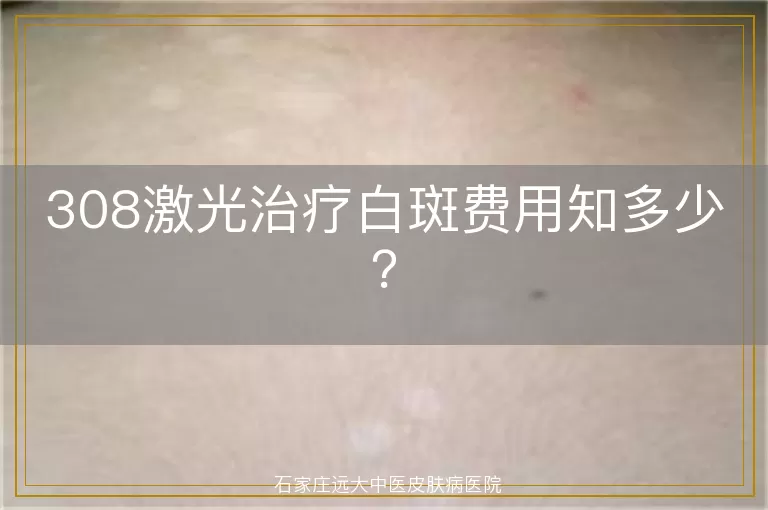 308激光治疗白斑费用知多少？