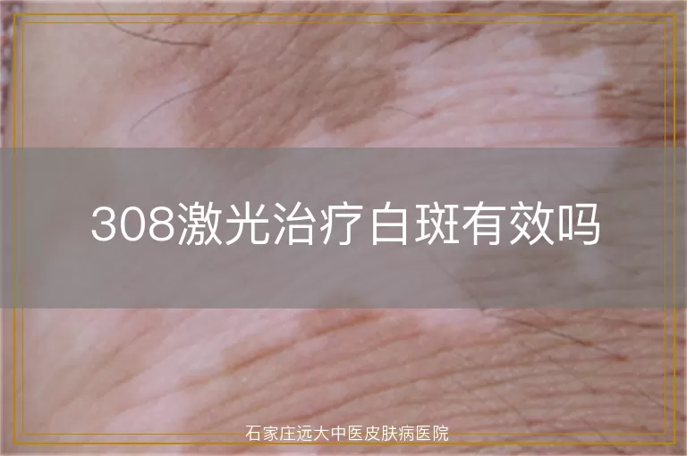 308激光治疗白斑有效吗
