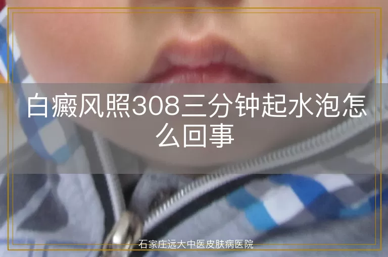 白癜风照308三分钟起水泡怎么回事