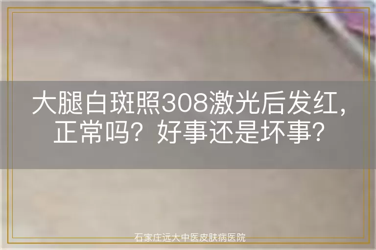 大腿白斑照308激光后发红，正常吗？好事还是坏事？