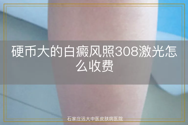 硬币大的白癜风照308激光怎么收费