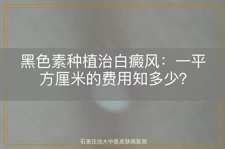 黑色素种植治白癜风：一平方厘米的费用知多少？