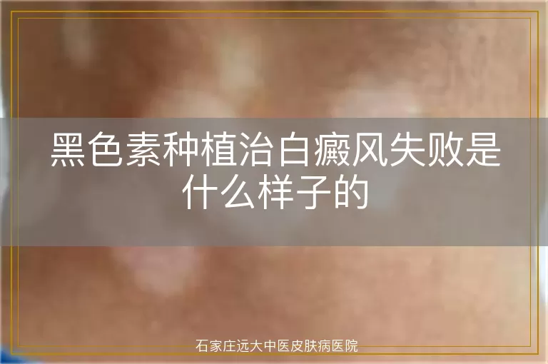 黑色素种植治白癜风失败是什么样子的