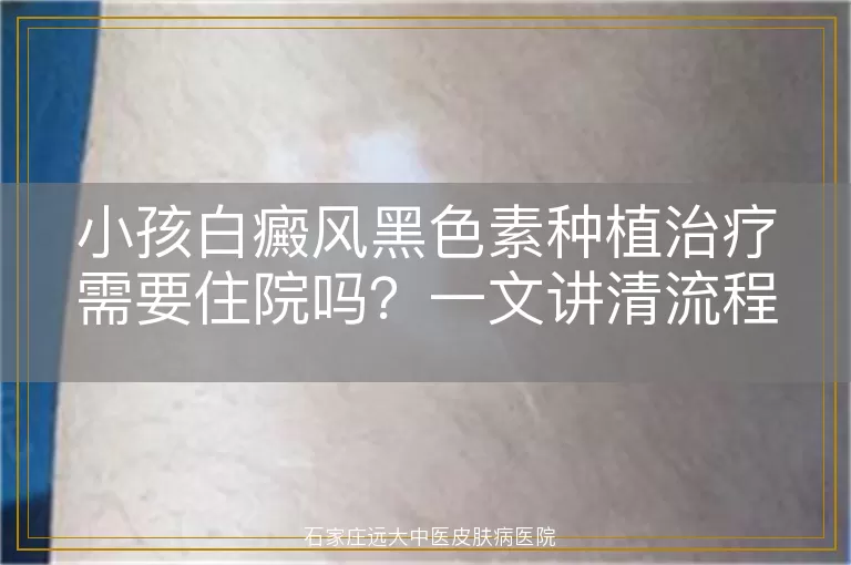 小孩白癜风黑色素种植治疗需要住院吗？一文讲清流程与注意事项