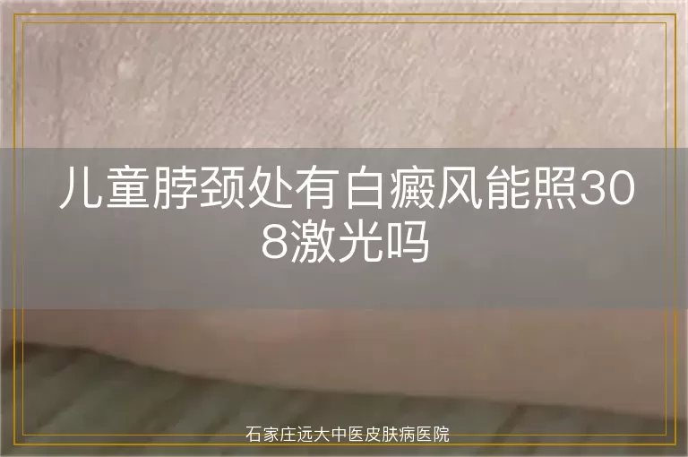 儿童脖颈处有白癜风能照308激光吗