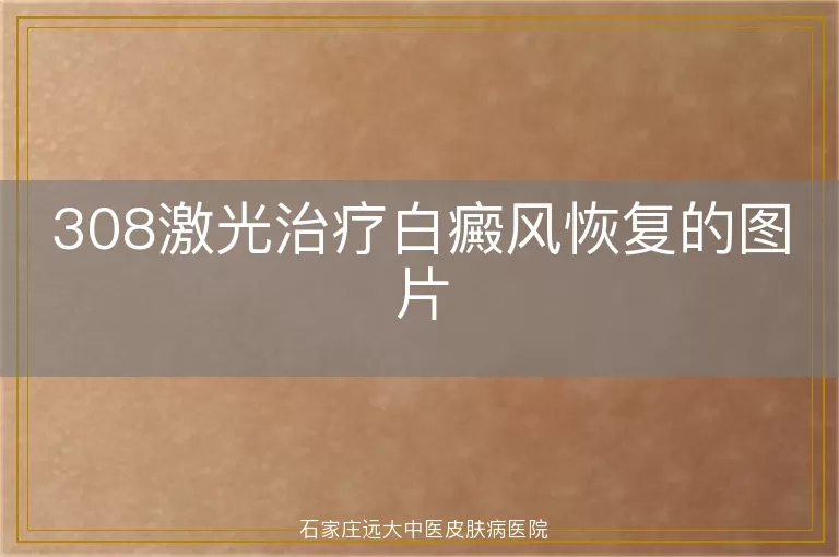 308激光治疗白癜风恢复的图片