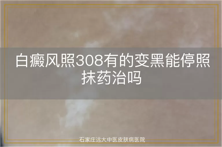 白癜风照308有的变黑能停照抹药治吗